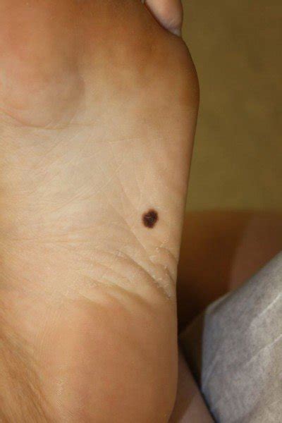 How long does it take for a blister to heal? How Fast Can Melanoma Spread After It First Appears ...