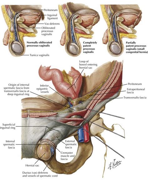 Inferior epigastric vessels running up abdominal wall. Open Inguinal Hernia Repair | Basicmedical Key