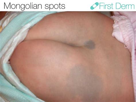 Mongolian spots (or mongolian blue spots) a bluish discolouration of the skin, may also cause worry among parents. Mongolian spots - Online Dermatology