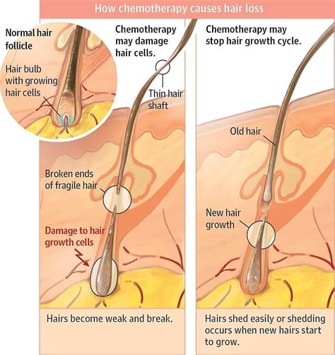 These side effects can include acne, weight gain, mood swings, decreased sex drive, and of course, hair loss. Why does CHEMO Cause HAIR LOSS ? - Medical Yukti