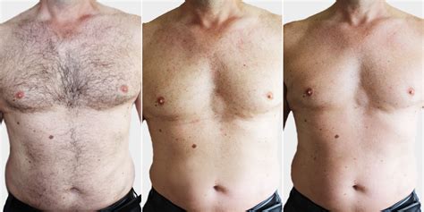 After 30 treatments, i'm done and here are the results. Elysion Laser Hair Removal Ayrshire - Elements of Life