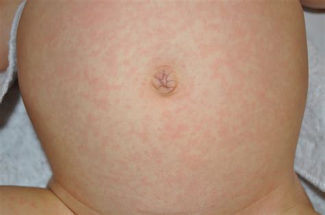 The most common cause of roseola is the human herpes virus 6, but the cause also can be another herpes virus — human herpes virus 7. Baby Rash Pictures, Causes, Treatments - Mommyhood101.com ...