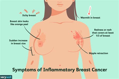 Read more about symptoms, which include skin irritation and skin inflammatory breast cancer (ibc) is rare, but aggressive, and can resemble an infection. Inflammatory Breast Cancer Armpit Rash