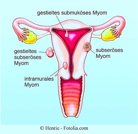 Wann muss eine hysterektomie durchgeführt werden? Myom, Symptome, Gebärmutter, Schmerzen, Blutung, Sarkom ...