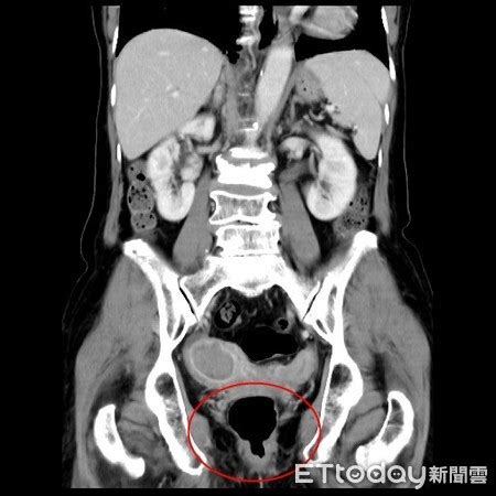 Include (or exclude) self posts. 台中7旬婦停經20年…私密處卻出血 竟是罕見「雙子宮併子宮內膜癌」 | ETtoday健康 | ETtoday新聞雲