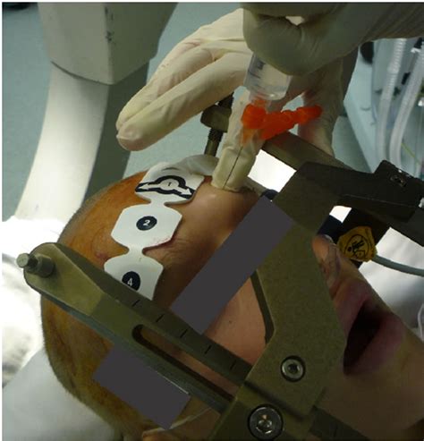 The Use of "Scalp Block" in Pediatric Patients