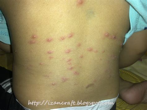 Pakar kulit anda mungkin boleh mendiagnosis acanthosis nigricans, tetapi untuk mendiagnosis rintangan insulin. Cik Puan Izan : Anakku Diserang Penyakit