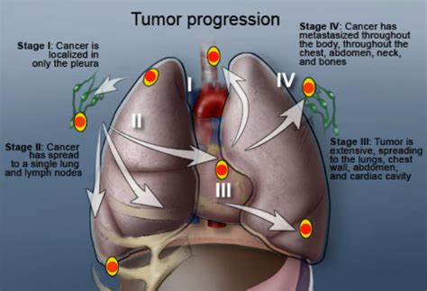 Maybe you would like to learn more about one of these? Give up tiers of Mesothelioma signs and symptoms