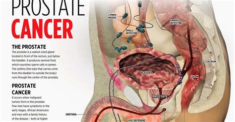 Most men with early prostate cancer have no symptoms or signs; The Truth About Prostate Cancer: The Truth About Prostate ...