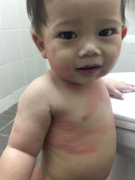 Bayi cirit birit dan kerap buang air besar apa patut saya buat theasianparent malaysia. 'Anak muntah 9 kali sehari, muka dan badan merah-merah ...