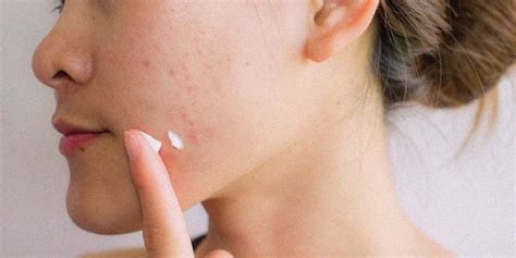 Tra gli alimenti ritenuti responsabili dell'acne, il cioccolato è probabilmente quello chiamato in causa più di frequente. Acido azelaico contro acne e brufoli | TuoBenessere.it