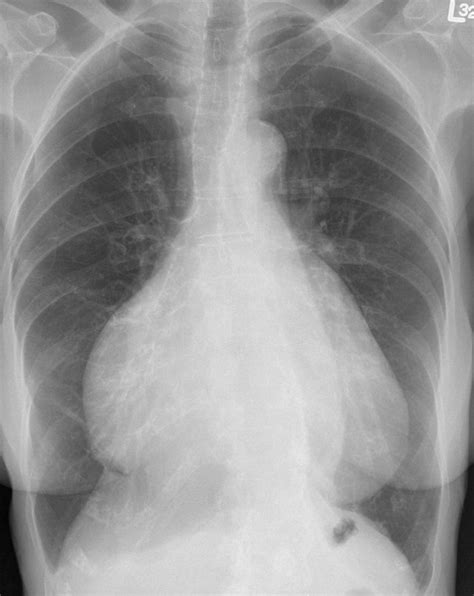 หัวใจโต ( cardiomegaly ) ภาวะหัวใจใหญ่กว่าปกติ ทำให้ความดันโลหิตสูง แต่หัวใจสูบฉีดเลือดได้ไม่ดี อาการเหนื่อยง่าย หายใจเร็ว เวียนหัว อ่อนเพลีย เท้า. บทความ เรื่องหัวใจโต พอดีหลานผมเป็นนะครับ - Pantip