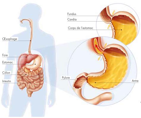 Brûlures d'estomac et acidité gastrique : Qu'est-ce qu'un cancer de l'estomac ? | Fondation ARC pour ...