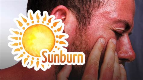 Batuk dan selsema adalah dua serangkai yang tidak dapat dielakkan. 7 Petua mudah hilangkan sunburn di wajah - YouTube