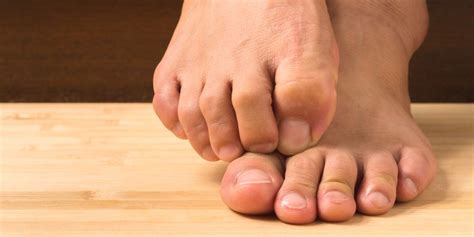 Learn how psoriasis, lung problems, and diabetes can cause foot symptoms. Overlapping Toes - The Complete Guide - Vive Health