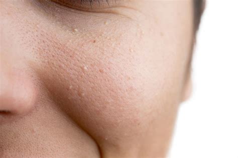 How long do the blooms last? How to get rid of milia: Treatment, prevention, and causes