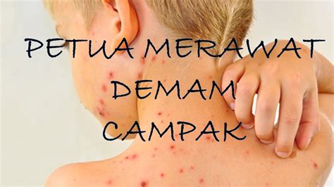 Pesakit demam campak biasanya mengalami gejala jangkitan respiratori dan disertai ruam pada kulit. Petua merawat demam campak anak-anak