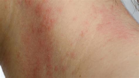 Baby milk allergy rash pictures and toddler milk allergy rash pictures. Skin Redness and Irritation - The Electrologist & Skin