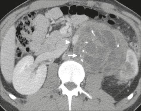 We did not find results for: Cystic Peritoneal Mesothelioma Radiology