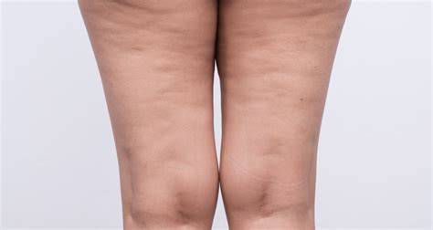 There are many purported cellulite treatments: Cellulite | Oorzaak, symptomen en behandeling