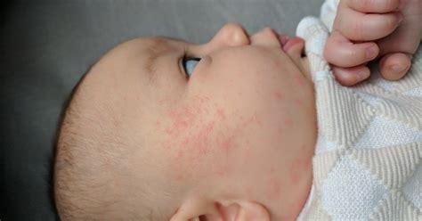 Just use a small amount of shampoo. How Often Should You Bathe A Baby With Eczema? Experts ...