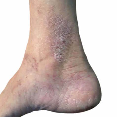 Дерматит симптомы диета дерматит на нервной почве чем лечить дерматит на нервной почве чем лечить Дерматит симптомы диета