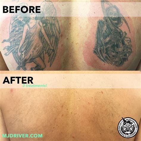 Discuss your skin concerns & possible treatment options with one of our highly trained clinical therapists! Laser tattoo removal at WA Ink by ...