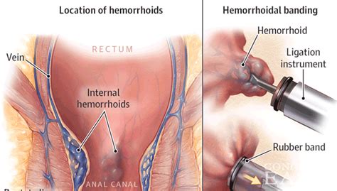 Bat l., melzer e., koler m., dreznick z., shemesh e. How Common are Hemorrhoids While Pregnant? | ConceiveEasy.com