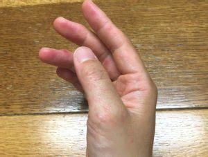 まさか自分が、相当かゆい!子供からうつった大人の手足口病 ...