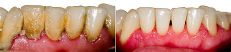 Dental plaque and tartar removal. Remove tartar at home? Be careful with DIY tips! - Dental ...