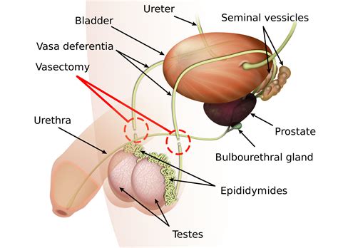 Do not lift anything (especially children of any age) and. Vasectomy