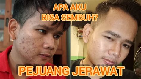 Tahu gak sih jenis jerawat apa yang nempel di muka kamu? BANYAK JERAWAT DI MUKA😭 | JANGAN TAKUT!! - YouTube