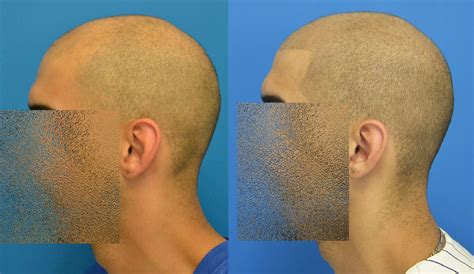 Hair tattoos for balding men. | Bald heads, Hairstyles for ...