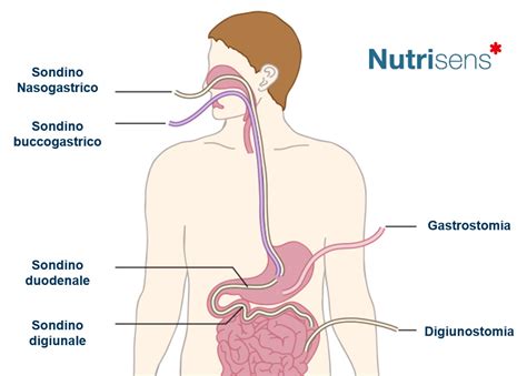 Pentru pacientii cu insuficienta renala acuta sau encefalopatie hepatica exista formule nutritive imbogatite in. Nutrizione Enterale | Nutrisens Italia