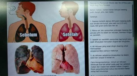 Radiator adalah komponen penting yang berguna untuk menurunkan dan menstabilkan suhu mesin. Viral! Ramuan Pembersih Paru-paru bagi Perokok, Benar Bisa ...