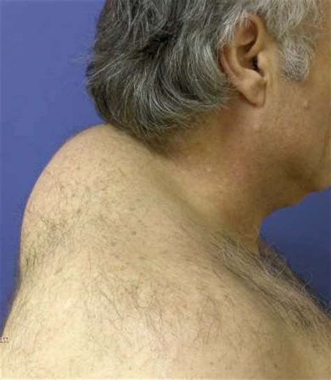 If the weather deteriorates, turn back. Buffalo Hump - Symptoms ,Causes ,Diagnosis And Treatment