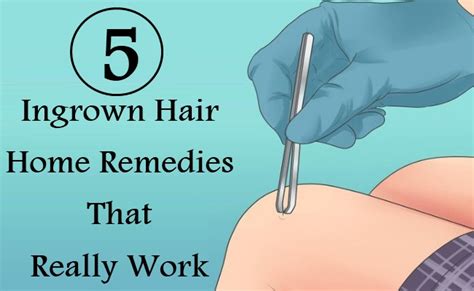 What does ingrown hair mean? 5 Ingrown Hair Home Remedies That Really Work | Lady Care ...