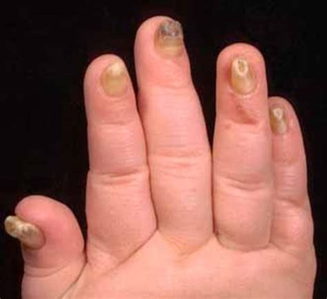 Neurocognitive impairment related to genetic conditions may be recognized in childhood; Nonsyndromic congenital nail disorder 10: MedlinePlus Genetics