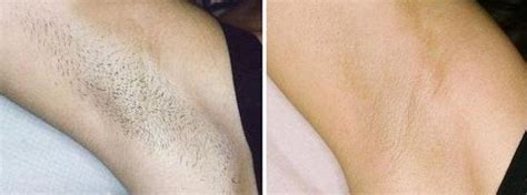 The best hair removal products can help you get rid of unwanted body hair. Auckland Laser Hair Removal