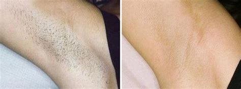 Bear in mind that the longer the hair, the more painful it will be. Auckland Laser Hair Removal