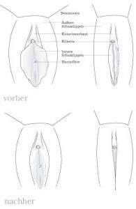 Oberhalb der clitoris, im bereich der clitoris (clitorismantel) und unterhalb der clitoris mit stellungskorrektur der clitoris bei hervorstehender clitoris (clitorisprotrusion). Schamlippenkorrektur - Enzyklopaedia Aesthetica