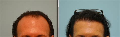 MTF Transgender Hair Transplant Dallas, Transexual Hair ...