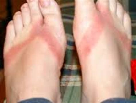 Allergic contact dermatitis (acd) result from inflammation caused primarily by a type iv hypersensitivity (delayed) cellular immune response. Itchy Rash on Top of Foot: Causes and Treatments | New ...