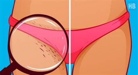 An ingrown hair is a hair that was knocked off course while trying to grow out from under the surface of the skin, says melanie coba, brand ambassador for european wax center. Oh No! Bad Ingrown Hairs After Brazilian Wax: What To Do?