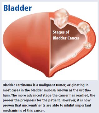 Maybe you would like to learn more about one of these? Benefits of Micronutrient Synergy in Bladder Cancer - Dr ...