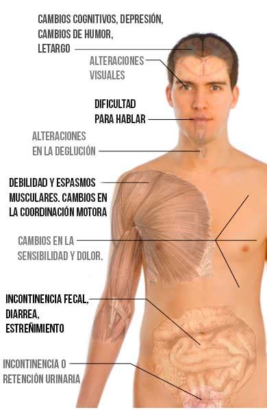 Retumban en nuestros oídos y en nuestros corazones la frase en fase terminal a causa de su esclerosis múltiple. ESCLEROSIS MÚLTIPLE - Síntomas y tratamiento • MD.Saúde