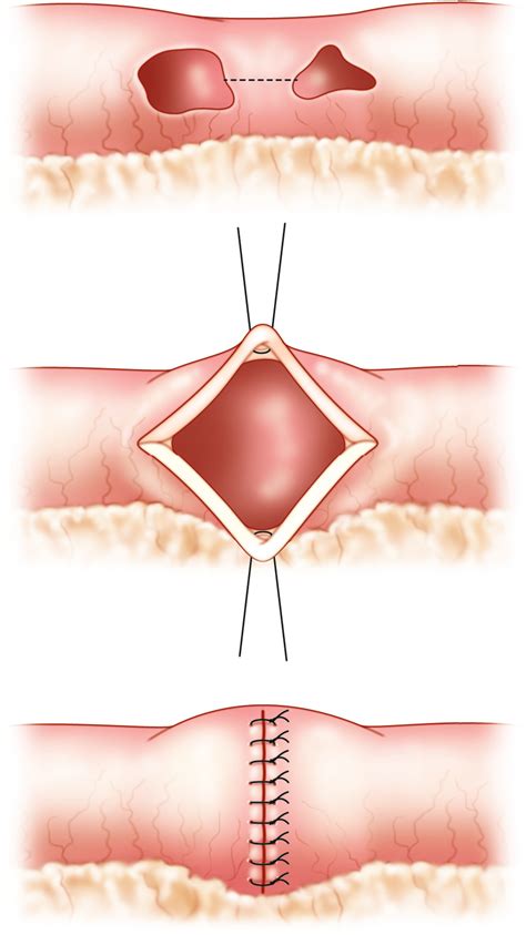 A colostomy is an opening (stoma) in the large intestine (colon), or the surgical procedure that creates one. Trauma of the Colon, Rectum, and Anus | SpringerLink