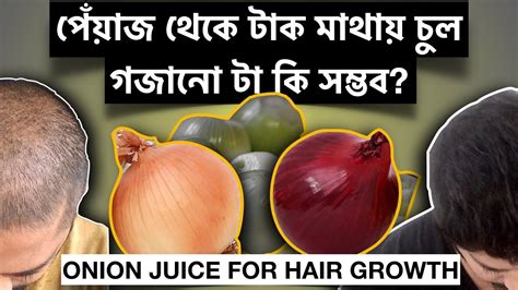 One of the best oils to use for the baldness and thinning hair. Onion Juice for Hair Growth | পেঁয়াজ থেকে টাক মাথায় চুল ...