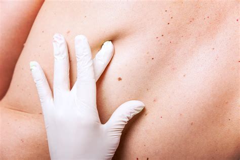 So, if after several weeks, the area treated is bleeding or oozing or just will not heal, then return to your dermatologist for. How to Know if a Mole is Skin Cancer - NewBeauty