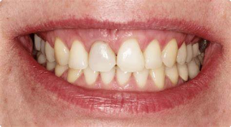 Диета удаление кисты